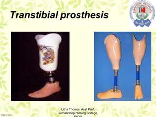 Transtibial prosthesis
Litha Thomas, Asst Prof,
Sumandeep Nursing College,
 
