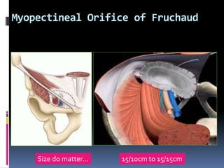 Myopectineal Orifice of Fruchaud
15/10cm to 15/15cmSize do matter…
 