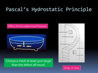 Pascal’s Hydrostatic Principle
OnlayVs Inlay
Effect of Intra abdominal Pressure
Choose a mesh at least 5cm larger
than the defect all round.
 