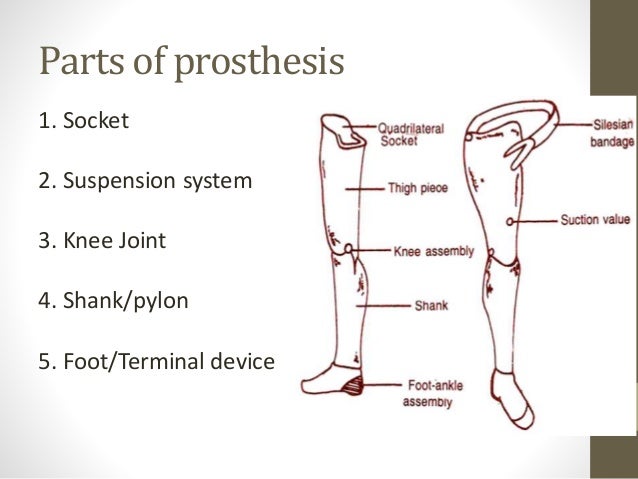 Prosthesis Definition Slideshare  : Prosthesis May Also Refer To: