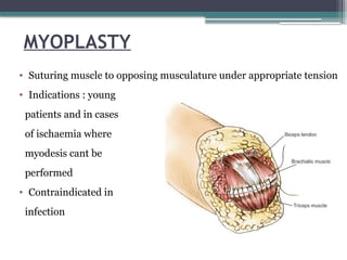 MYOPLASTY
• Suturing muscle to opposing musculature under appropriate tension
• Indications : young
patients and in cases
of ischaemia where
myodesis cant be
performed
• Contraindicated in
infection
 