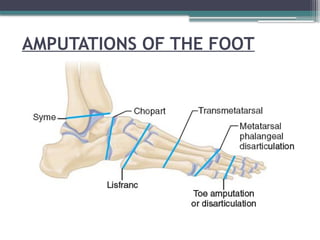 AMPUTATIONS OF THE FOOT
 