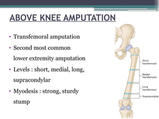 ABOVE KNEE AMPUTATION
• Transfemoral amputation
• Second most common
lower extremity amputation
• Levels : short, medial, long,
supracondylar
• Myodesis : strong, sturdy
stump
 