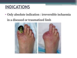 INDICATIONS
• Only absolute indication : irreversible ischaemia
in a diseased or traumatized limb
 