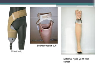 Waist belt
Supracondylar cuff
External Knee Joint with
corset
 