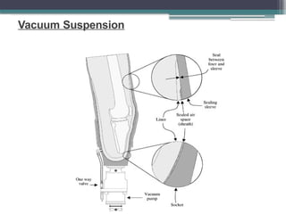 Vacuum Suspension
 