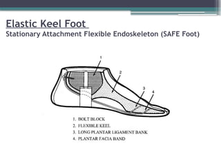 Elastic Keel Foot
Stationary Attachment Flexible Endoskeleton (SAFE Foot)
 