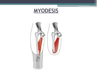 MYODESIS
 