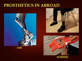 PROSTHETICS IN ABROAD
3D PRINTING
C-LEG
 