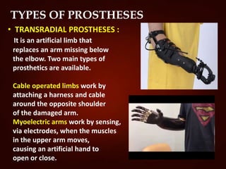 TYPES OF PROSTHESES
• TRANSRADIAL PROSTHESES :
It is an artificial limb that
replaces an arm missing below
the elbow. Two main types of
prosthetics are available.
Cable operated limbs work by
attaching a harness and cable
around the opposite shoulder
of the damaged arm.
Myoelectric arms work by sensing,
via electrodes, when the muscles
in the upper arm moves,
causing an artificial hand to
open or close.
 