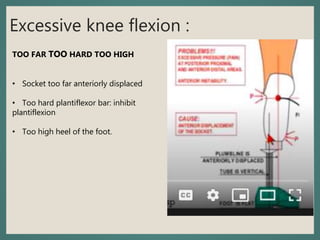 Excessive knee flexion :
TOO FAR TOO HARD TOO HIGH
• Socket too far anteriorly displaced
• Too hard plantiflexor bar: inhibit
plantiflexion
• Too high heel of the foot.
 