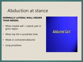 Abduction at stance
NORMALLY LATERAL WALL HIGHER
THAN MEDIAL
• When medial wall > Lateral, pain in
groin region
• When hip OA in prosthetic limb.
• Weak or contracted abductor
• Long prosthesis
 