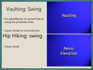 Vaulting: Swing
◦ It is plantiflexion of normal limb to
swing the prosthetic limb.
◦ Cause: similar to circumduction
Hip Hiking: swing
◦ Cause: simlar
 