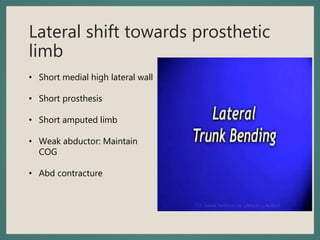 Lateral shift towards prosthetic
limb
• Short medial high lateral wall
• Short prosthesis
• Short amputed limb
• Weak abductor: Maintain
COG
• Abd contracture
 