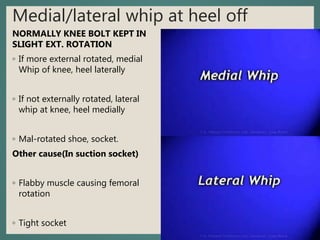 Medial/lateral whip at heel off
NORMALLY KNEE BOLT KEPT IN
SLIGHT EXT. ROTATION
◦ If more external rotated, medial
Whip of knee, heel laterally
◦ If not externally rotated, lateral
whip at knee, heel medially
◦ Mal-rotated shoe, socket.
Other cause(In suction socket)
◦ Flabby muscle causing femoral
rotation
◦ Tight socket
 