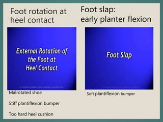 Foot rotation at
heel contact
Malrotated shoe
Stiff plantiflexion bumper
Too hard heel cushion
Foot slap:
early planter flexion
Soft plantiflexion bumper
 