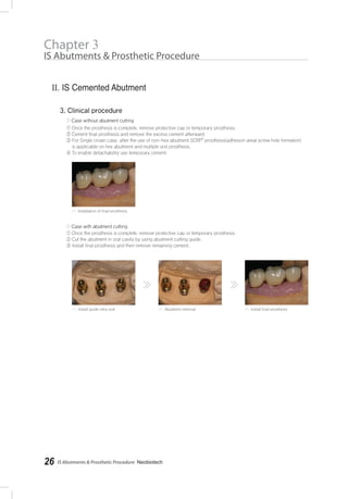 IS Abutments & Prosthetic Procedure- Neobiotech26
Chapter 3
IS Abutments & Prosthetic Procedure
R
 