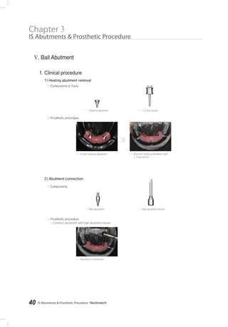 IS Abutments & Prosthetic Procedure- Neobiotech40
Chapter 3
IS Abutments & Prosthetic Procedure
 