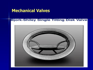 Mechanical Valves
 