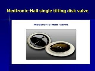 Medtronic-Hall single tilting disk valve
 