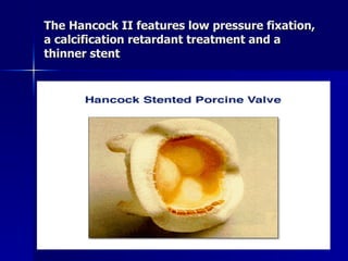 The Hancock II features low pressure fixation,
a calcification retardant treatment and a
thinner stent
 