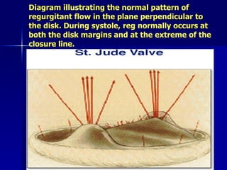 Diagram illustrating the normal pattern of
regurgitant flow in the plane perpendicular to
the disk. During systole, reg normally occurs at
both the disk margins and at the extreme of the
closure line.
 