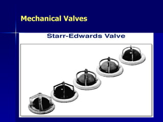 Mechanical Valves
 