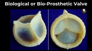 Biological or Bio-Prosthetic Valve
 