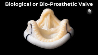 Biological or Bio-Prosthetic Valve
 