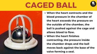 CAGED BALL
When the heart contracts and the
blood pressure in the chamber of
the heart exceeds the pressure on
the outside of the chamber, the
ball is pushed against the cage and
allows blood to flow.
When the heart finishes
contracting, the pressure inside
the chamber drops and the ball
moves back against the base of the
valve forming a seal.
 