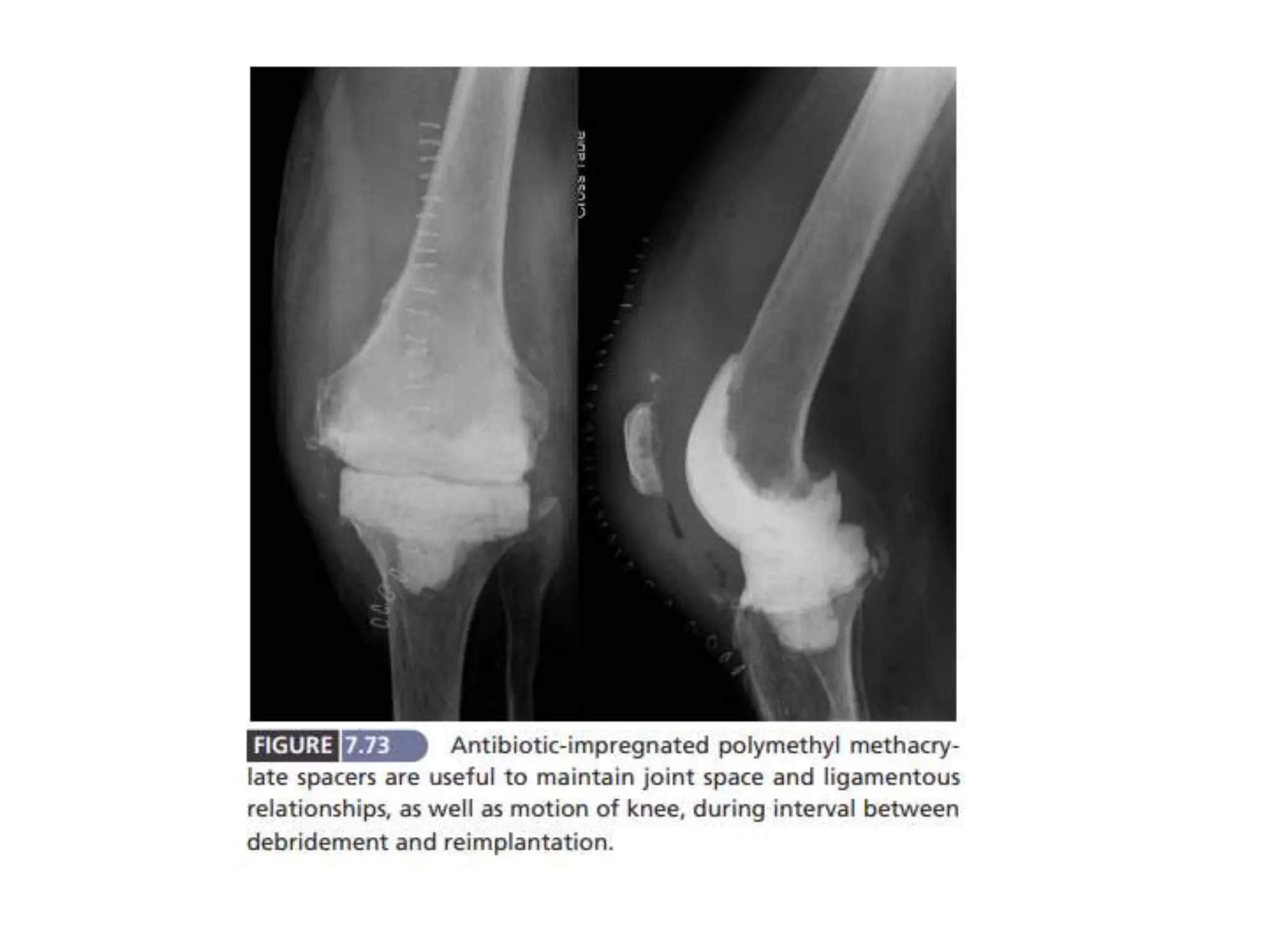 Prosthetic joint infection in detail powerpoint | PPTX