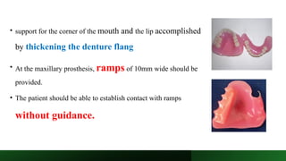Maxillary Ramps Prosthetic Management for Resected Mandible.pptx