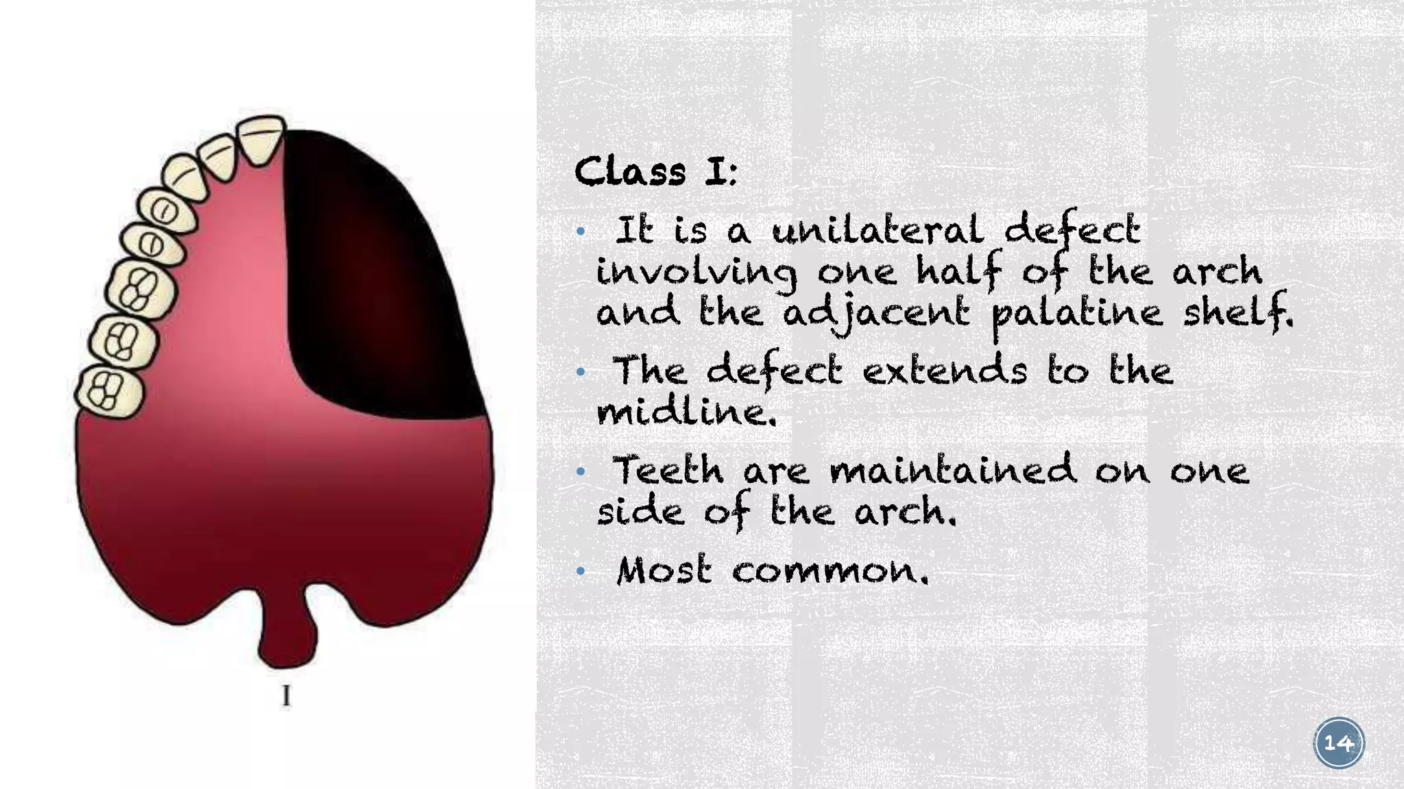 Maxillary Defects Classification Prosthetic Management of Acquired Maxillary Defects | PDF