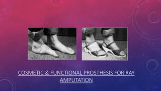 COSMETIC & FUNCTIONAL PROSTHESIS FOR RAY
AMPUTATION
 