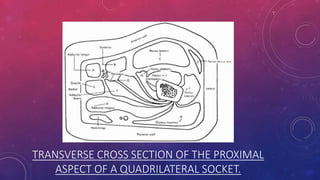 TRANSVERSE CROSS SECTION OF THE PROXIMAL
ASPECT OF A QUADRILATERAL SOCKET.
 
