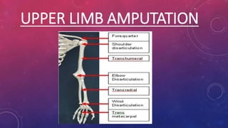 UPPER LIMB AMPUTATION
 