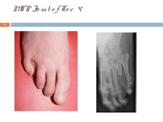 MTP Jo int o f To e 4
11
 