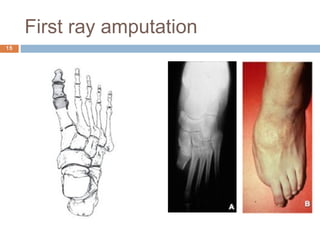 Prosthetic management of symes and partial foot amputation | PPT