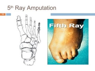 Prosthetic management of symes and partial foot amputation | PPT