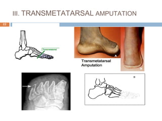III. TRANSMETATARSAL AMPUTATION
22
 