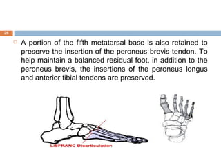  A portion of the fifth metatarsal base is also retained to
preserve the insertion of the peroneus brevis tendon. To
help maintain a balanced residual foot, in addition to the
peroneus brevis, the insertions of the peroneus longus
and anterior tibial tendons are preserved.
26
 