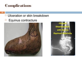 Complications
 Ulceration or skin breakdown
 Equinus contracture
30
 