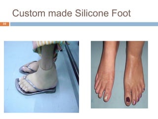 Prosthetic management of symes and partial foot amputation | PPT