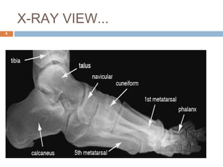 Prosthetic management of symes and partial foot amputation | PPT