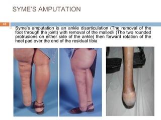 SYME’S AMPUTATION
 Syme’s amputation is an ankle disarticulation (The removal of the
foot through the joint) with removal of the malleoli (The two rounded
protrusions on either side of the ankle) then forward rotation of the
heel pad over the end of the residual tibia
46
 