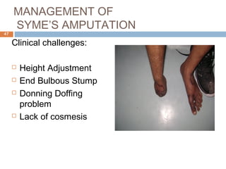 Prosthetic management of symes and partial foot amputation | PPT
