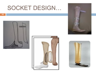 Prosthetic management of symes and partial foot amputation | PPT