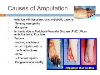 Causes of Amputation
 Infection with tissue necrosis in diabetic patients
 Sensory neuropathy
 Gangrene
 Ischemia due to Peripheral Vascular Disease (PVD) ,Micro
emboli arteritis, Frostbite
 Trauma
-moving machinery
-crush injuries, with or
without fractures
-RTA
- Thermal injuries
 Congenital abnormality
5
 
