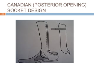 CANADIAN (POSTERIOR OPENING)
SOCKET DESIGN
50
 