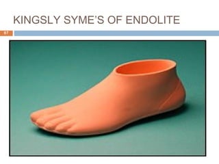 KINGSLY SYME’S OF ENDOLITE
67
 